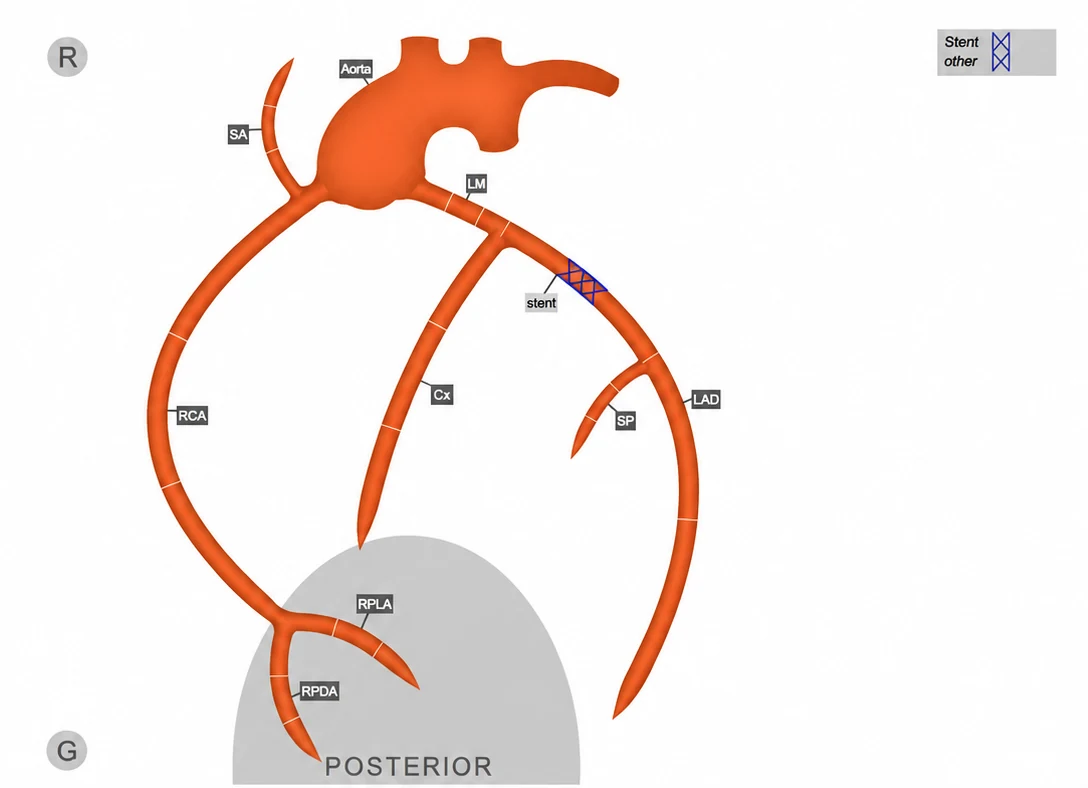 CardioDoc ACR interactive coronary artery diagram (Aorta, LM, LAD, Cx, RCA, RPLA, RPDA vessel labels with stent placement)