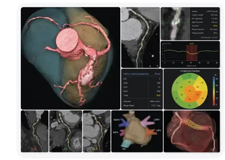 CT Cardiac