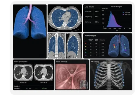 CT Chest