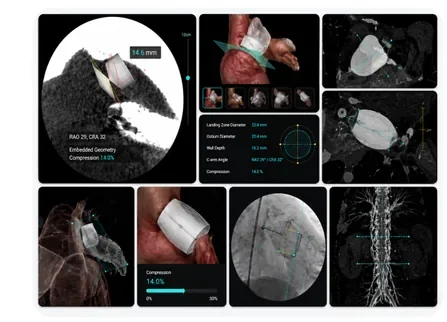 Left Atrial Appendage (LAA) Workflow