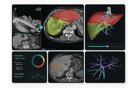 Liver Segmentation