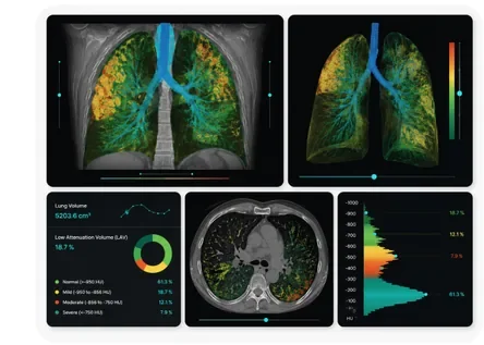 Lung Density Analysis II