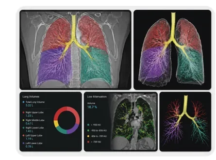 Lung Segmentation