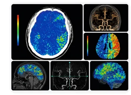 Neuro Perfusion Maps