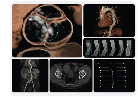 TAVR Workflow