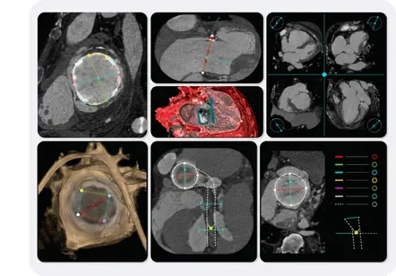 TMVR (Mitral Valve) Workflow